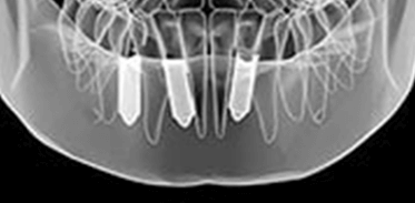 Dental Implants X-Ray